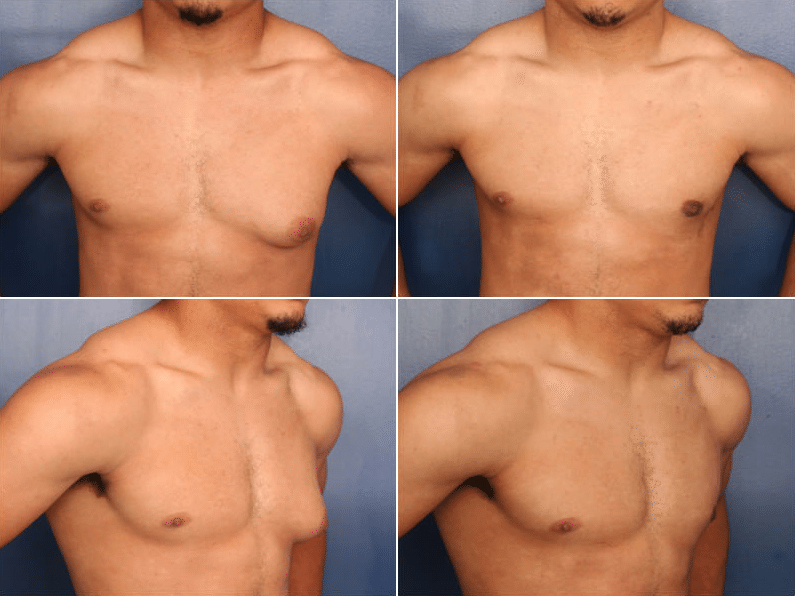 A before and after image of Dr. Schuster's gynecomastia patient