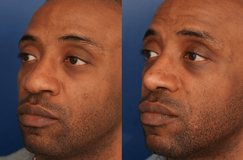 A before and after image of Dr. Schuster's rhinoplasty patient