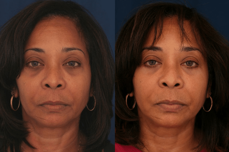 A before and after image of Dr. Schuster's blepharoplasty patient