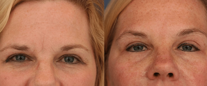 A before and after image of one of Dr. Schuster's Dysport patients