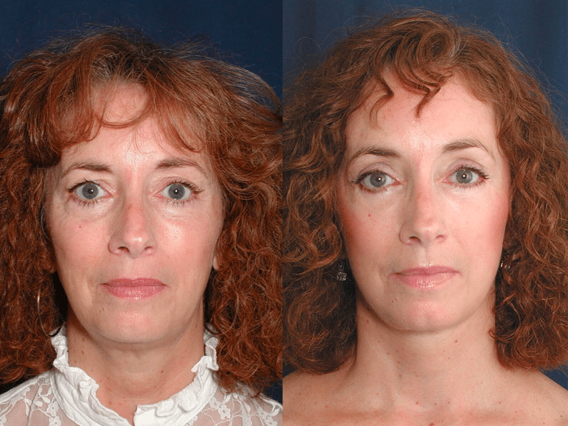 A before and after photo of Dr. Schuster's Baltimore facelift patient