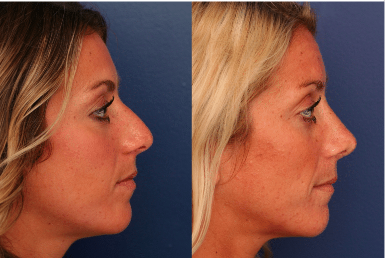 A before and after image of Dr. Schuster's rhinoplasty patient