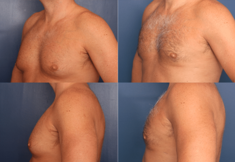 A before and after image of Dr. Schuster's gynecomastia patient