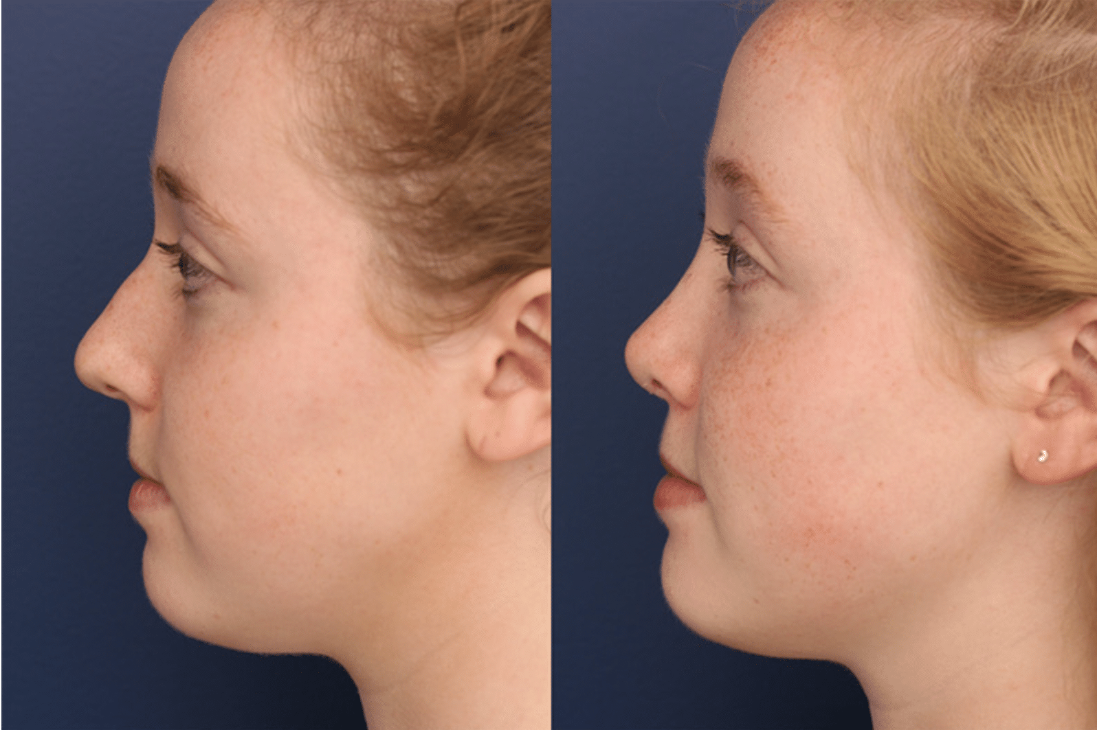 A before and after profile image of a rhinoplasty patient