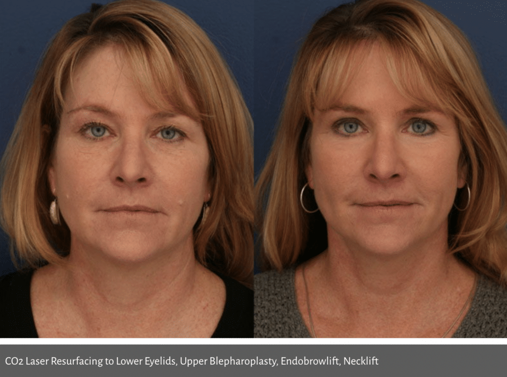 A before and after image of a woman who received laser resurfacing and other procedures