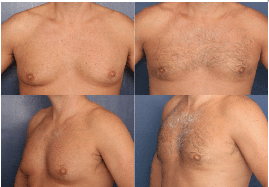 Before and after images of Baltimore gynecomastia patient