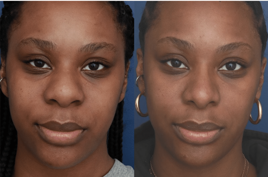 A before and after photo of Dr. Schuster's female rhinoplasty patient