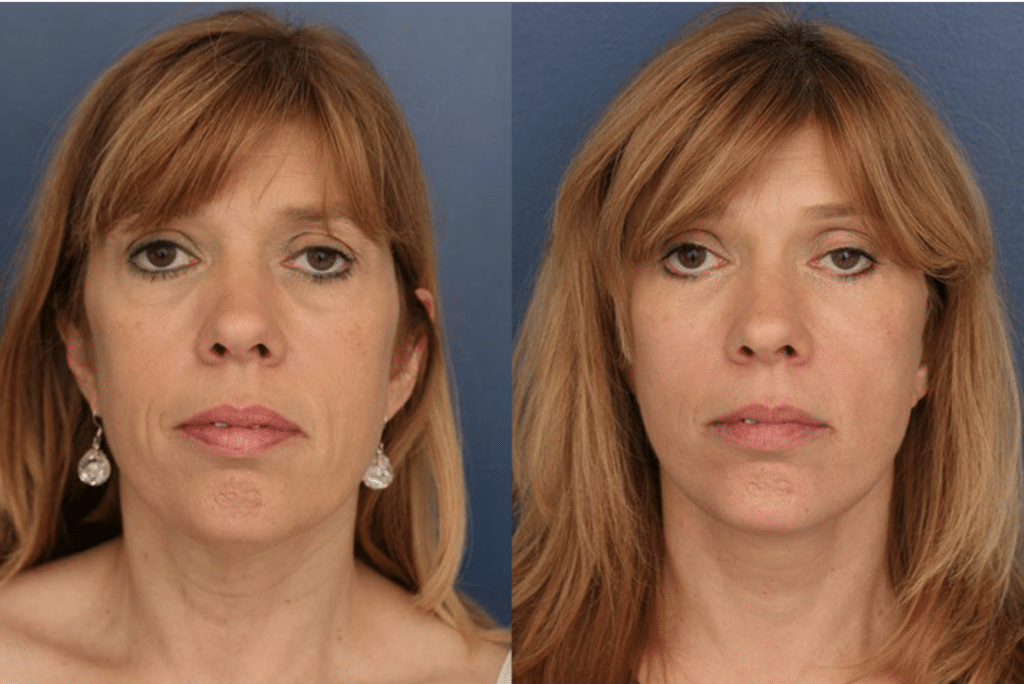 A before and after image of Dr. Ronald Schuster's Baltimore facelift patient
