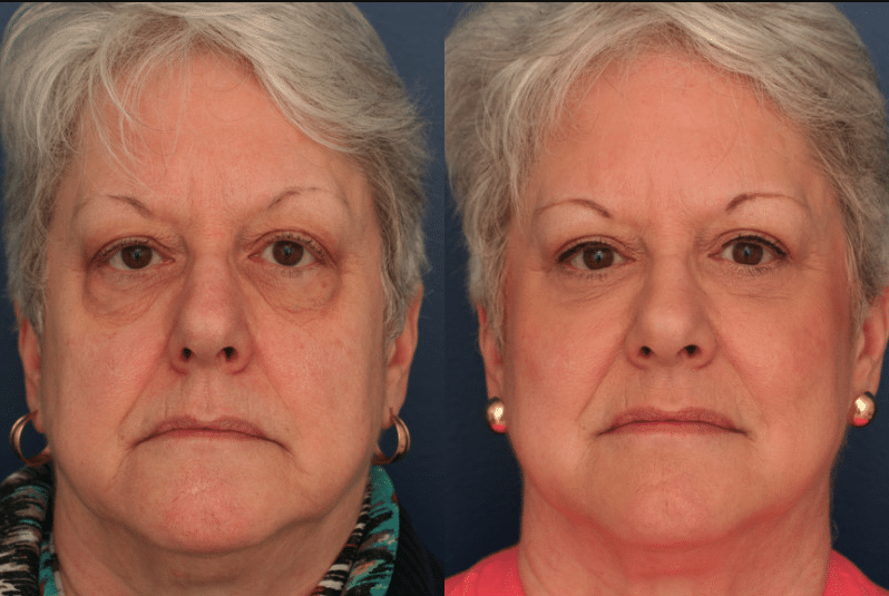 Eyelid surgery by Dr. Ronald Schuster before and after
