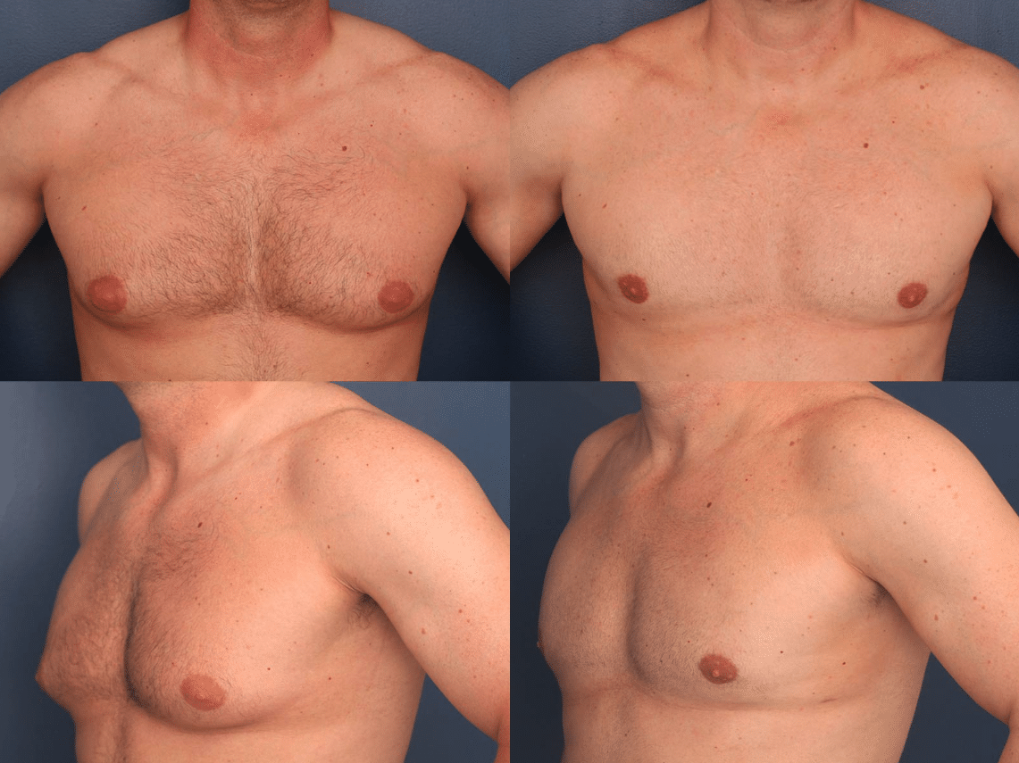 gyno before after