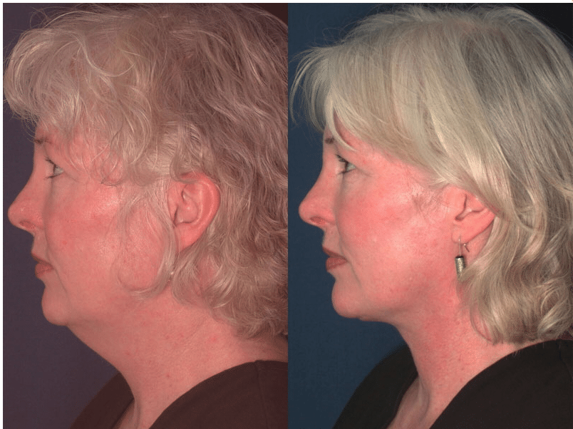 Neck lift before and after photos
