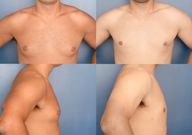 gynecomastia surgery before and after photos minimal scarring