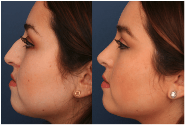 rhinoplasty before and after images