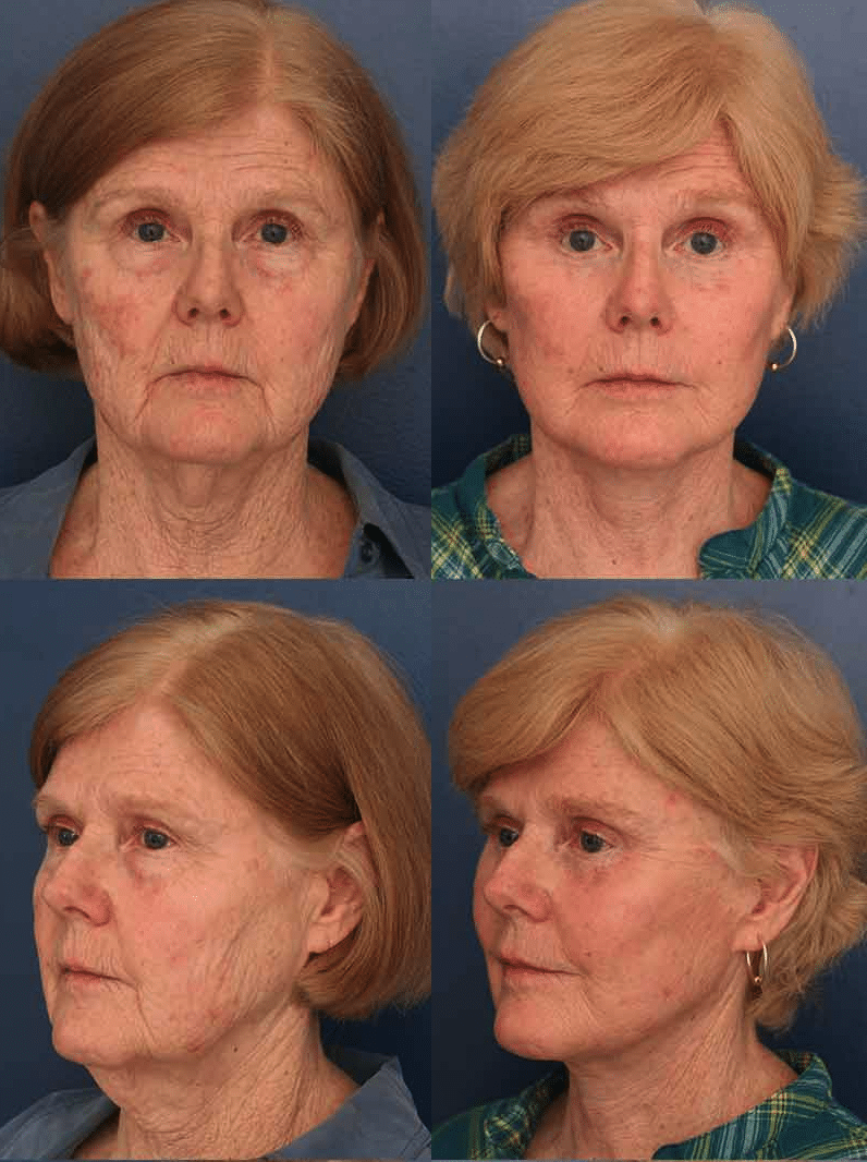 facelift before after images