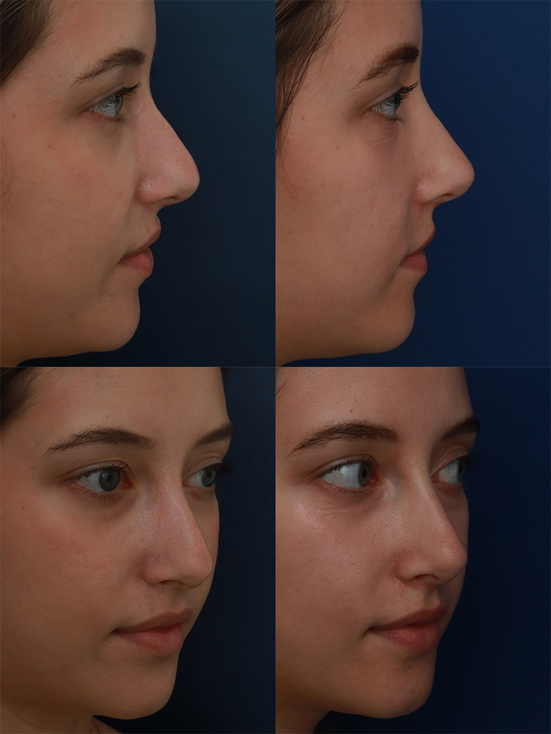 young woman before and after non-surgical rhinoplasty nose job from front and side view