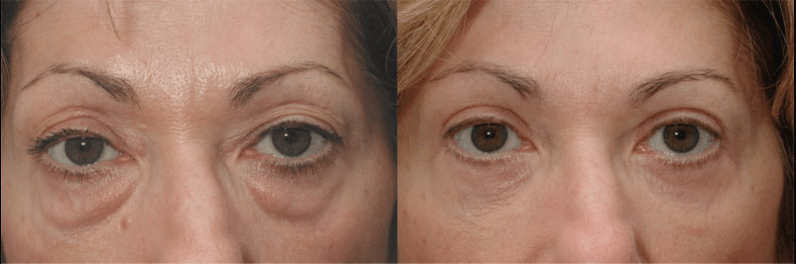 before and after eyelid surgery 