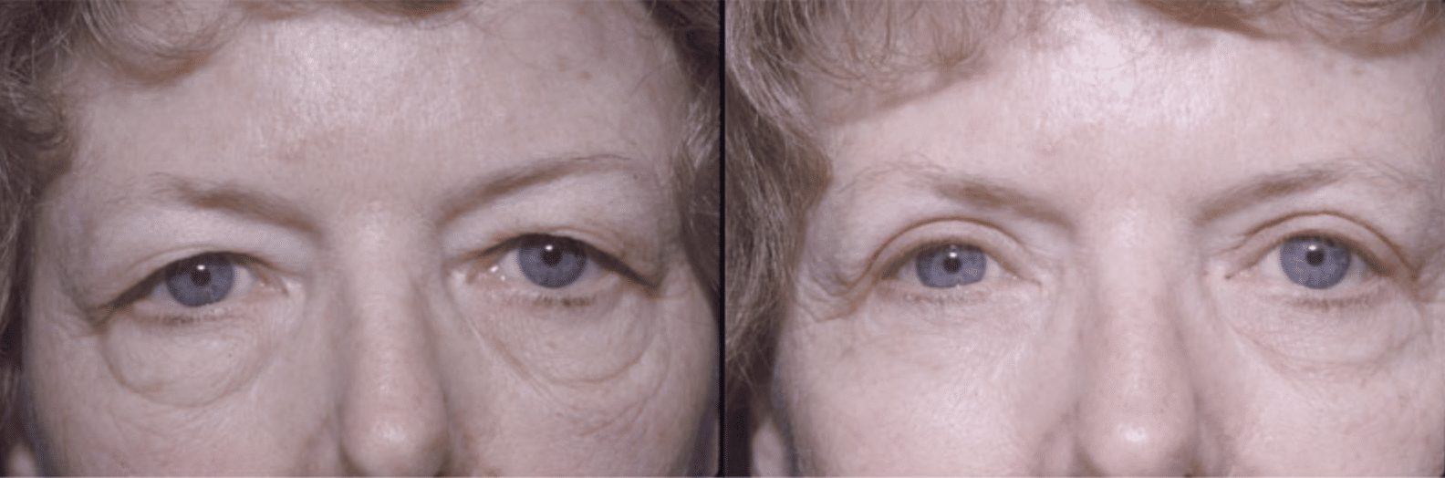 blepharoplasty before after