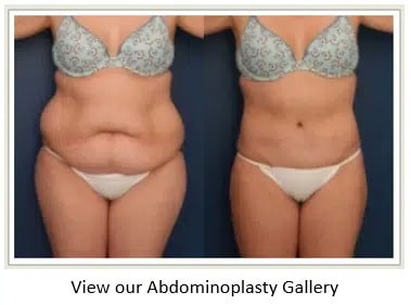 woman before and after tummy tuck with less much stomach fat after procedure