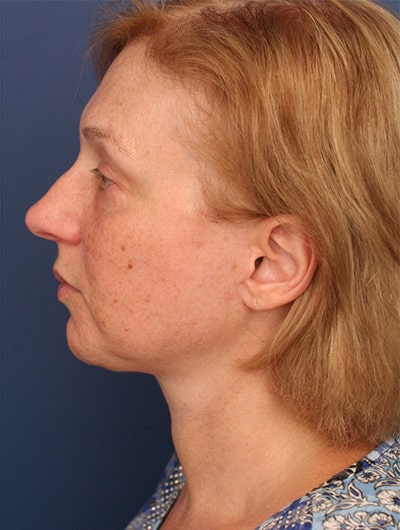 After Image: Facelift - left-side