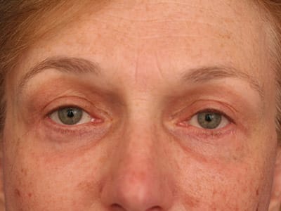 After Image: Facelift - front