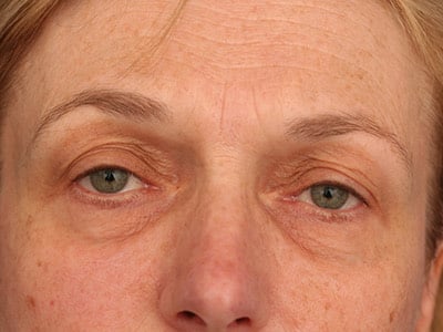 Before Image: Facelift - front
