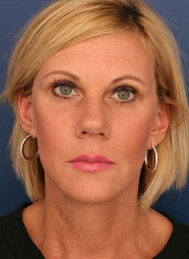 After Image: Facelift - front