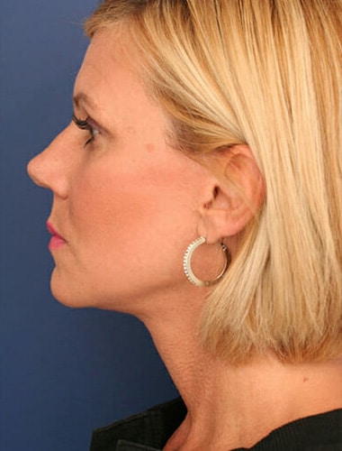 After Image: Facelift - left-side