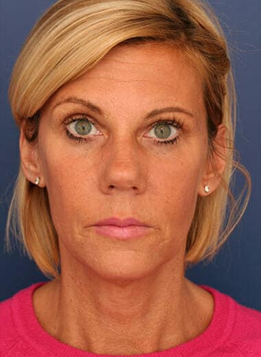 Before Image: Facelift - front