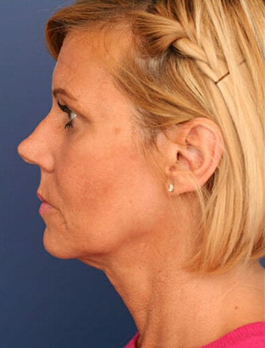 Before Image: Facelift - left-side