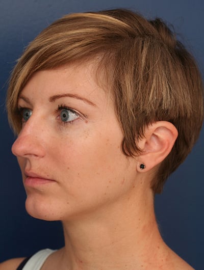 After Image: Neck Lift - left-front-oblique