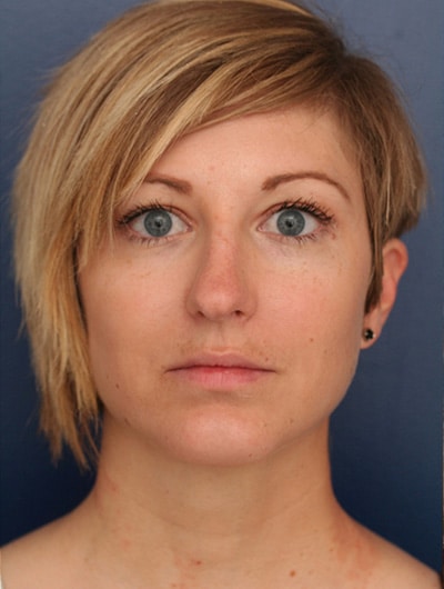 After Image: Neck Lift - front