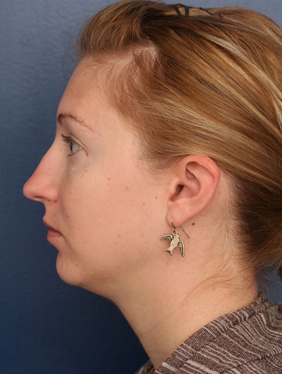Before Image: Neck Lift - left-side