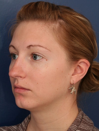 Before Image: Neck Lift - left-front-oblique