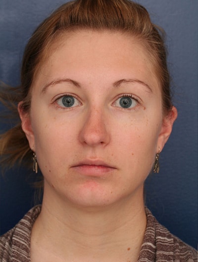 Before Image: Neck Lift - front