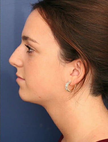 After Image: Neck Lift - left-side