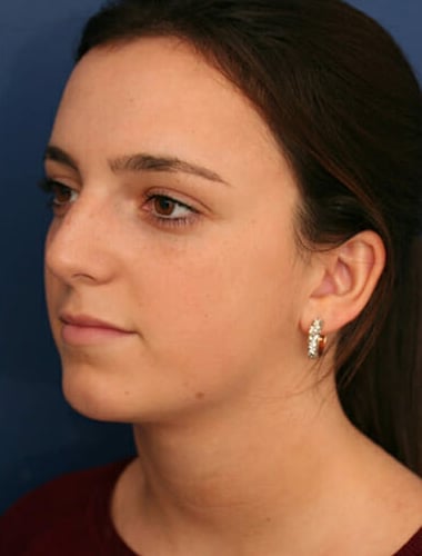 After Image: Neck Lift - left-front-oblique