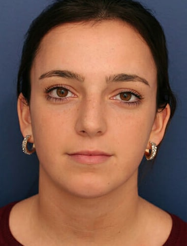 After Image: Neck Lift - front