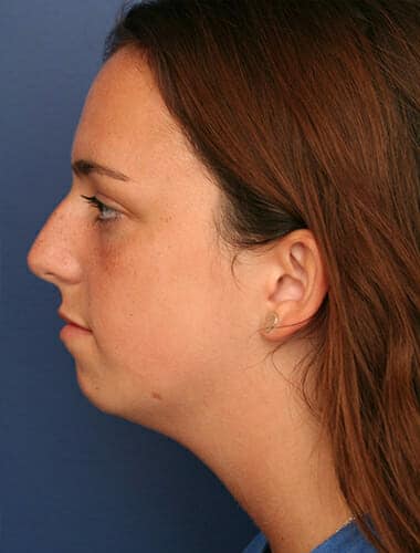 Before Image: Neck Lift - left-side