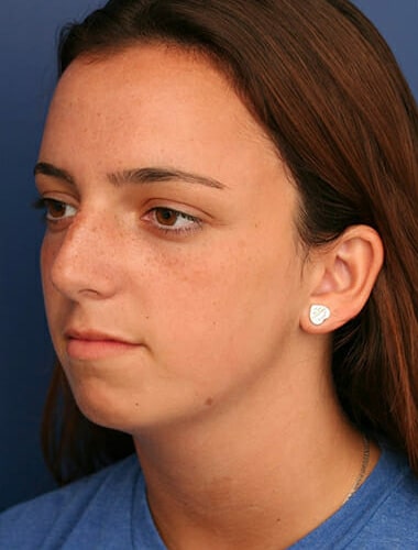 Before Image: Neck Lift - left-front-oblique