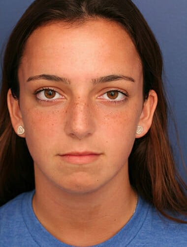 Before Image: Neck Lift - front
