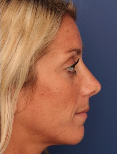After Image: Rhinoplasty - right-side