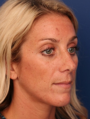 After Image: Rhinoplasty - right-front-oblique