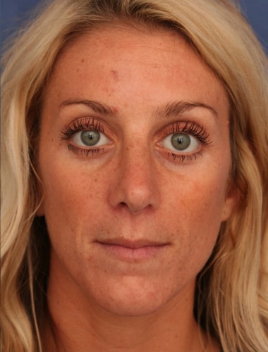 After Image: Rhinoplasty - front