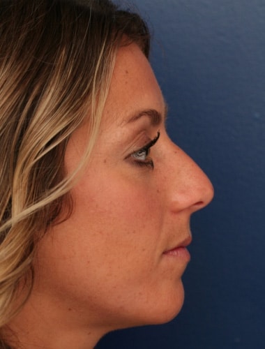 Before Image: Rhinoplasty - right-side