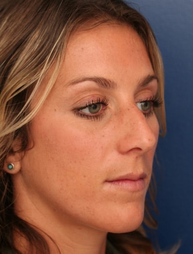 Before Image: Rhinoplasty - right-front-oblique