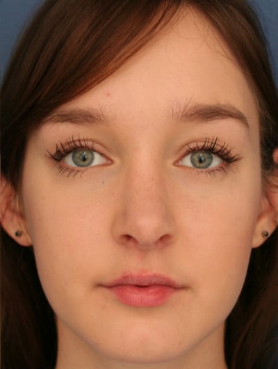 After Image: Rhinoplasty -