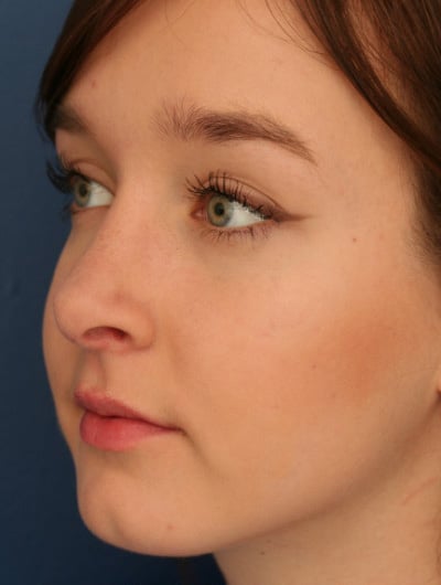 After Image: Rhinoplasty -
