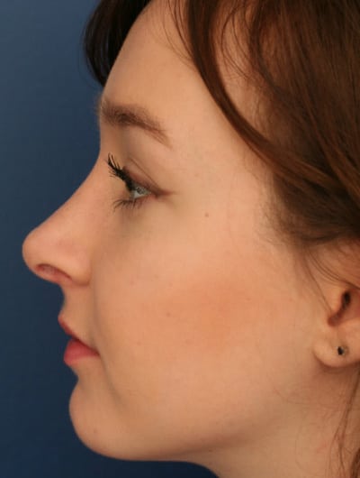 After Image: Rhinoplasty - left-side