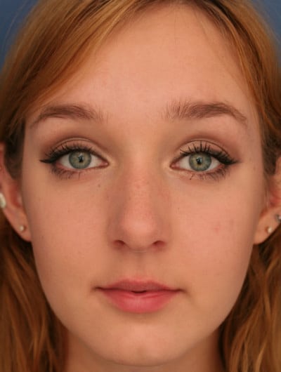 Before Image: Rhinoplasty -