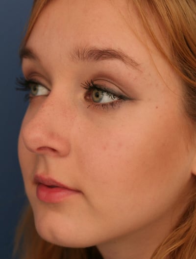Before Image: Rhinoplasty -